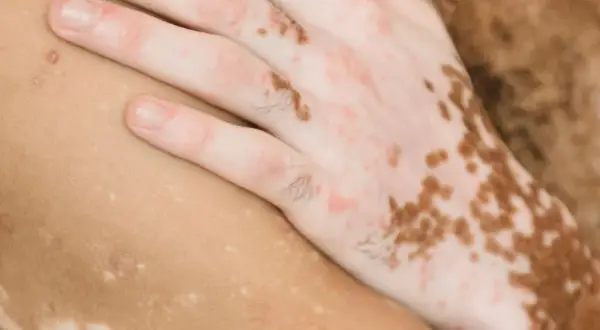 Närbild på en hand och arm med vitiligo. Vita prickar i jorden på huden skapar ett unikt mönster.