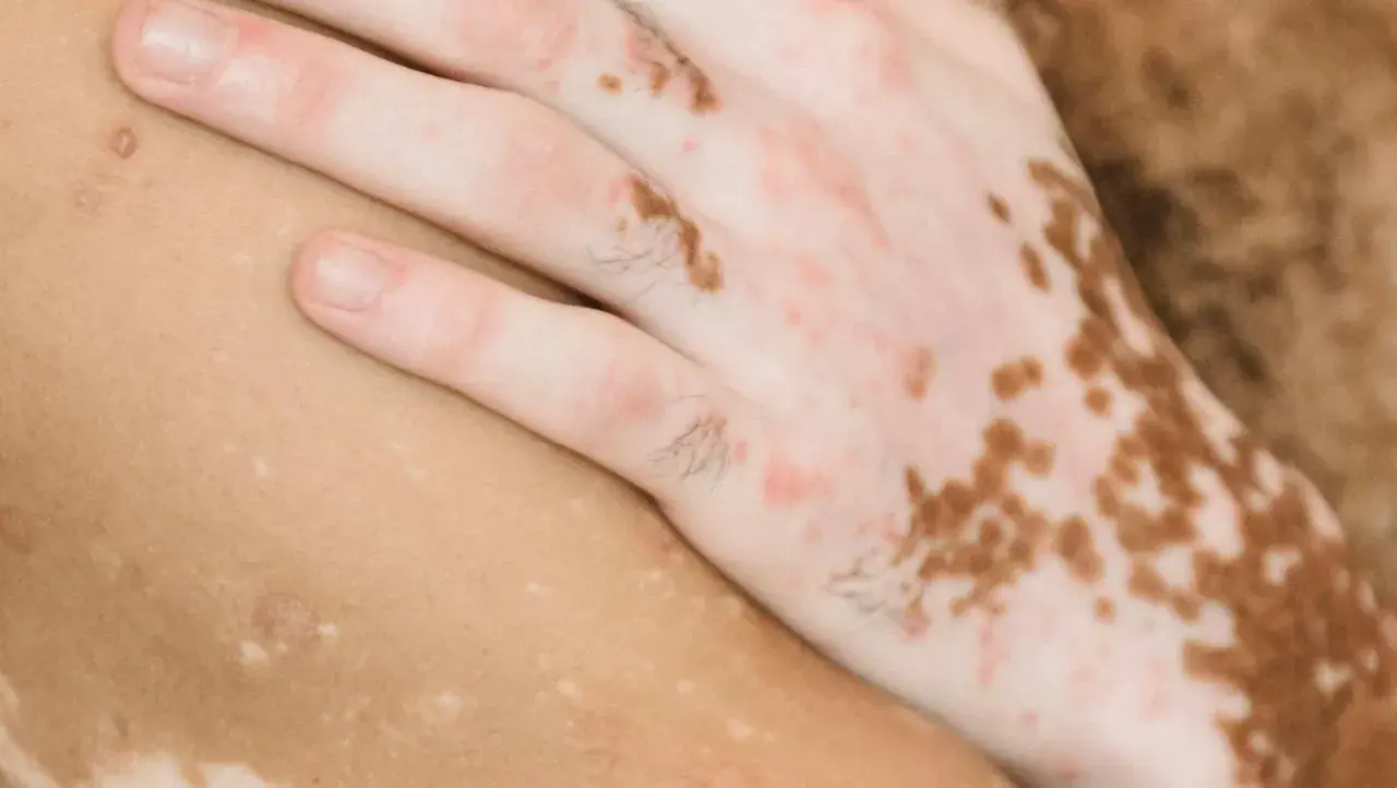 Närbild på en hand och arm med vitiligo. Vita prickar i jorden på huden skapar ett unikt mönster.
